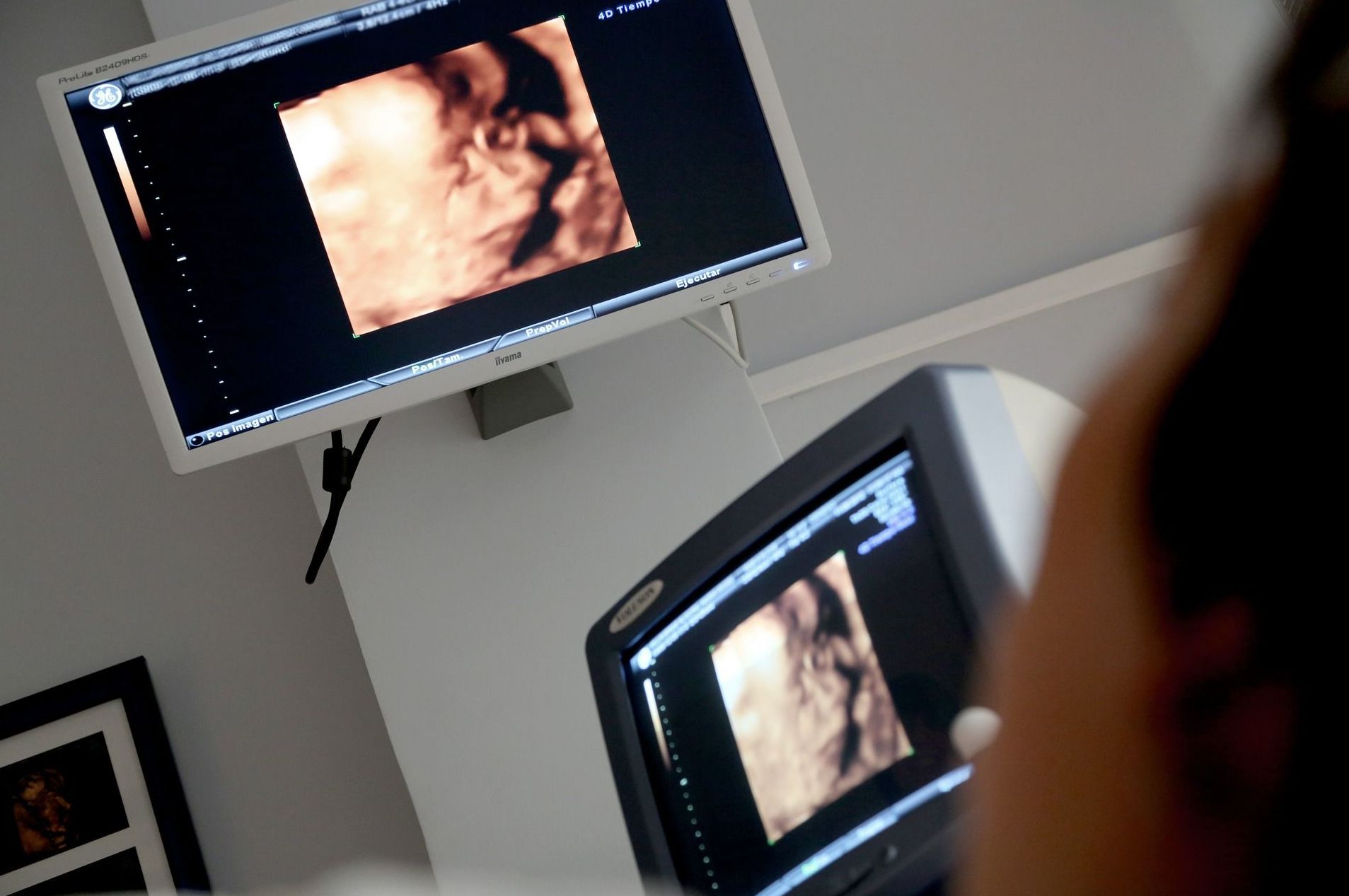 Diagnóstrico prenatal en Palencia