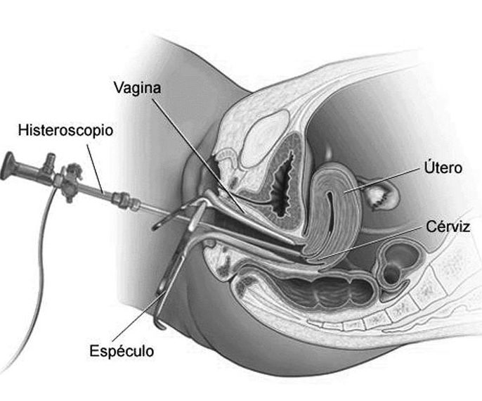 Histeroscopia: Servicios de Dr. José Mª Vaca Vaca