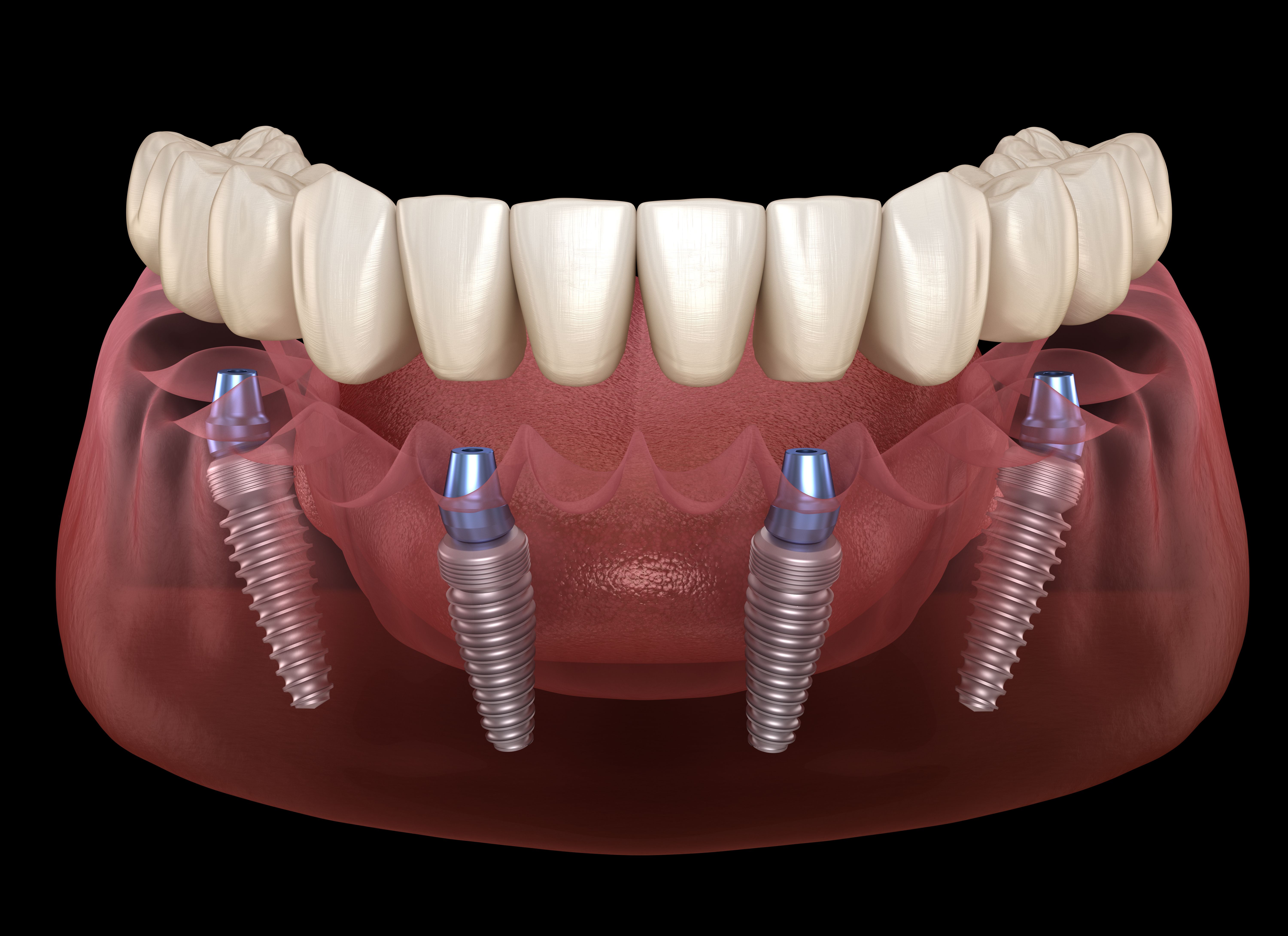 Implantes dentales en Madrid centro