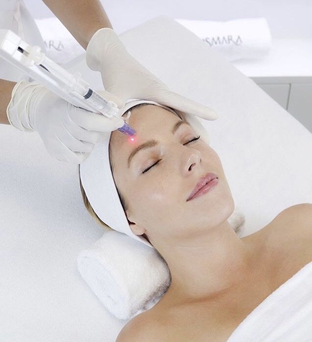 MICRONEEDLING: Tratamientos de Montserrat Travé, Clínica Anti-aging y Estética Avanzada MICRONEEDLING: Tratamientos de Montserrat Travé, Clínica Anti-aging y Estética Avanzada