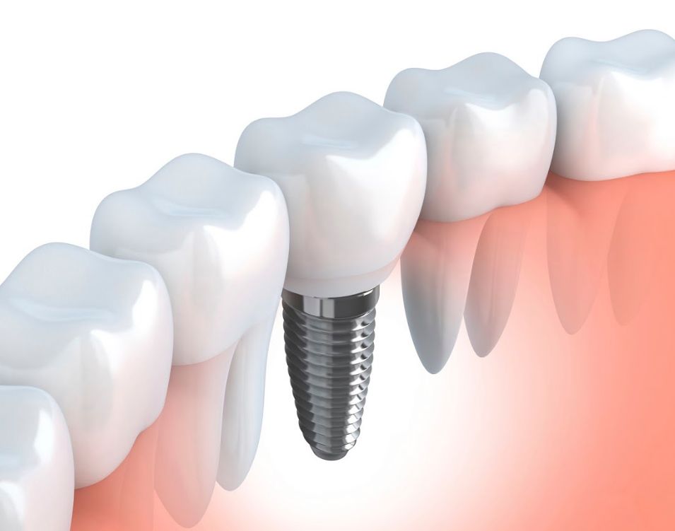 Implantología: Tratamientos de Clínica Dental Dentimar Implantología: Tratamientos de Clínica Dental Dentimar