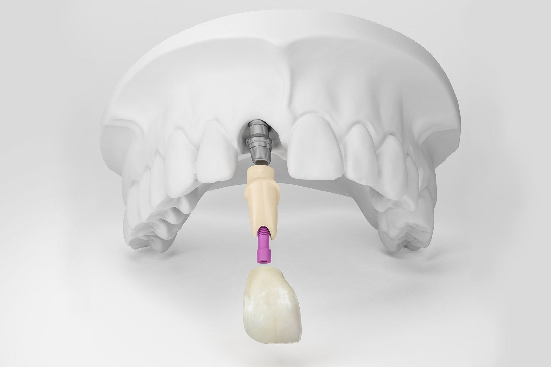 Implantología: Tratamientos y servicios de Institut Dental Sils Implantología: Tratamientos y servicios de Institut Dental Sils