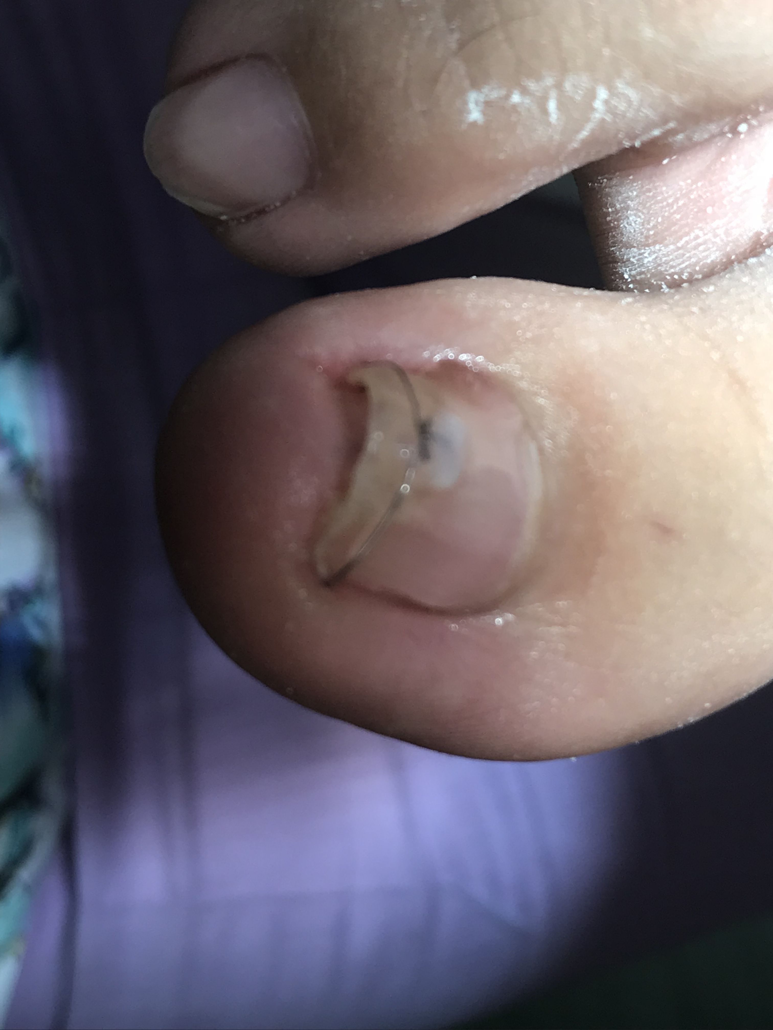 Hongos en los pies: Servicios de Clínica Valpie Hongos en los pies: Servicios de Clínica Valpie