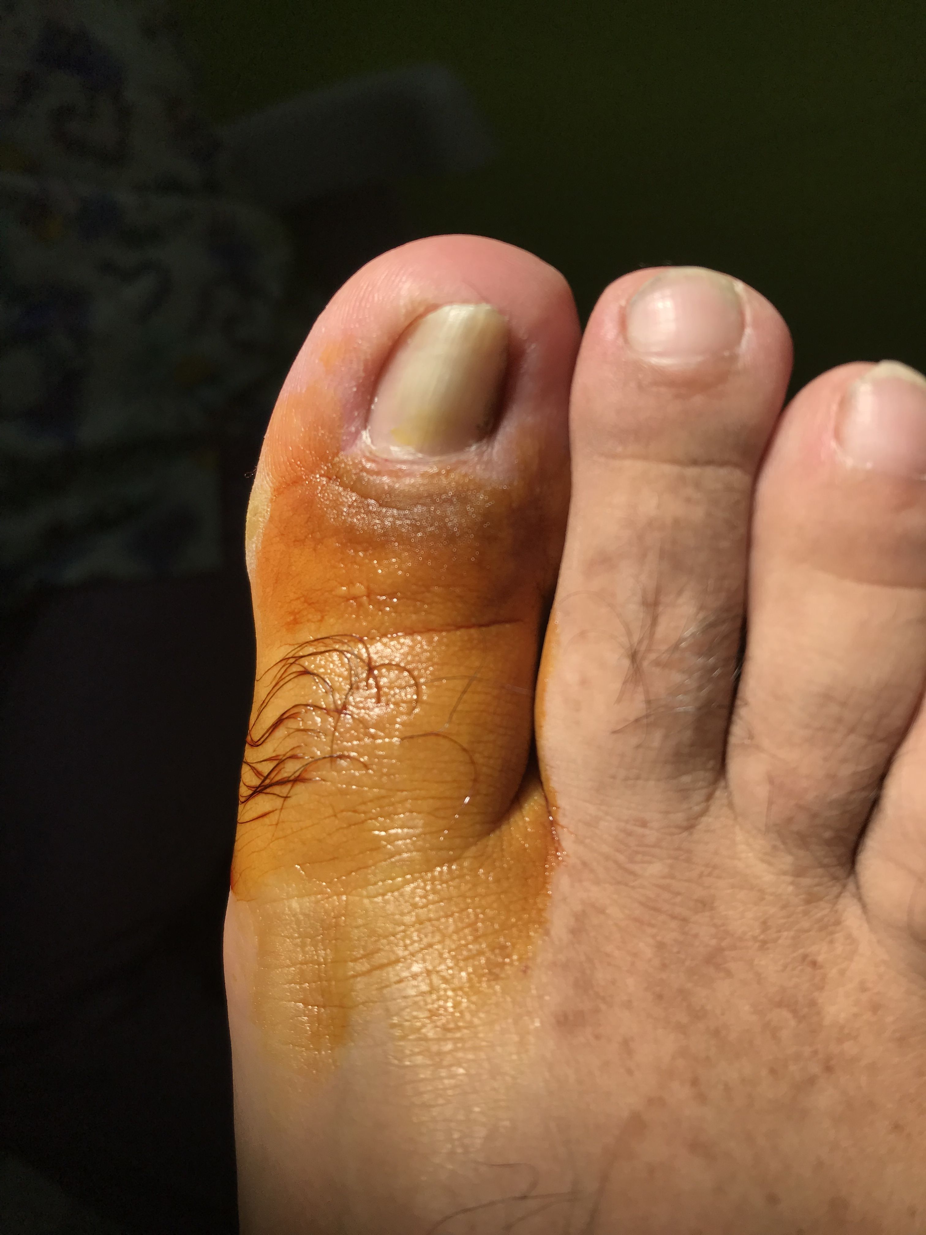 Hongos en los pies: Servicios de Clínica Valpie Hongos en los pies: Servicios de Clínica Valpie