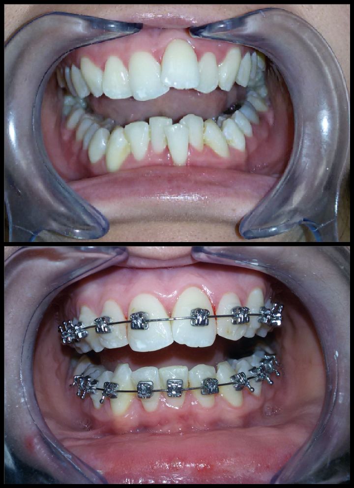 Ortodoncia: Tratamientos de Moncloa Clínica Dental Ortodoncia: Tratamientos de Moncloa Clínica Dental
