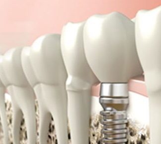 Implantología: Tratamientos de Dental Park Implantología: Tratamientos de Dental Park