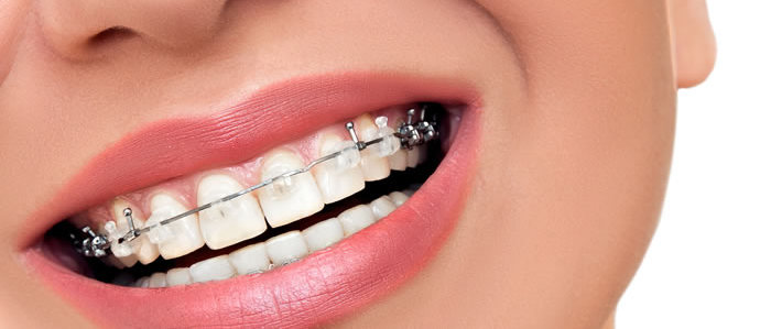 Ortodoncia: Tratamientos de Moncloa Clínica Dental Ortodoncia: Tratamientos de Moncloa Clínica Dental