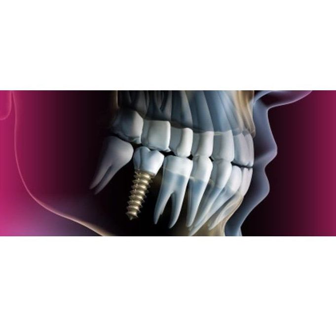 Guía quirúrgica: Tratamientos de Moncloa Clínica Dental Guía quirúrgica: Tratamientos de Moncloa Clínica Dental