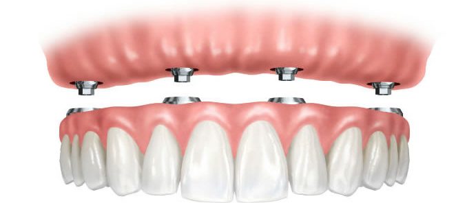 Prótesis: Tratamientos de Moncloa Clínica Dental Prótesis: Tratamientos de Moncloa Clínica Dental