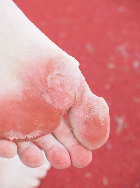 Hiperqueratosis (dureza común): Tratamientos de Clínica Podológica Ercilla Hiperqueratosis (dureza común): Tratamientos de Clínica Podológica Ercilla