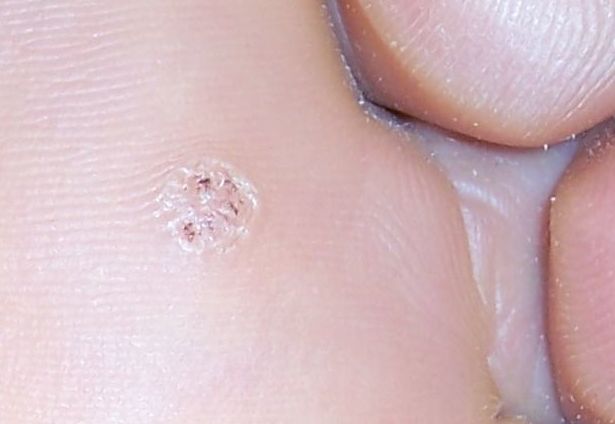 Papilomas (verrugas plantares): Tratamientos de Clínica Podológica Ercilla Papilomas (verrugas plantares): Tratamientos de Clínica Podológica Ercilla
