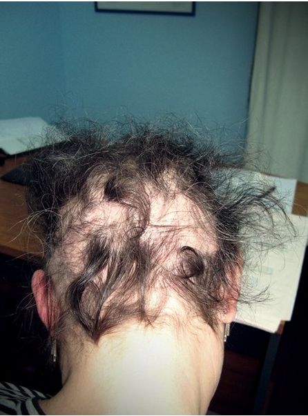 Tratamientos antes y después: Servicios de Dermocap Tratamientos antes y después: Servicios de Dermocap