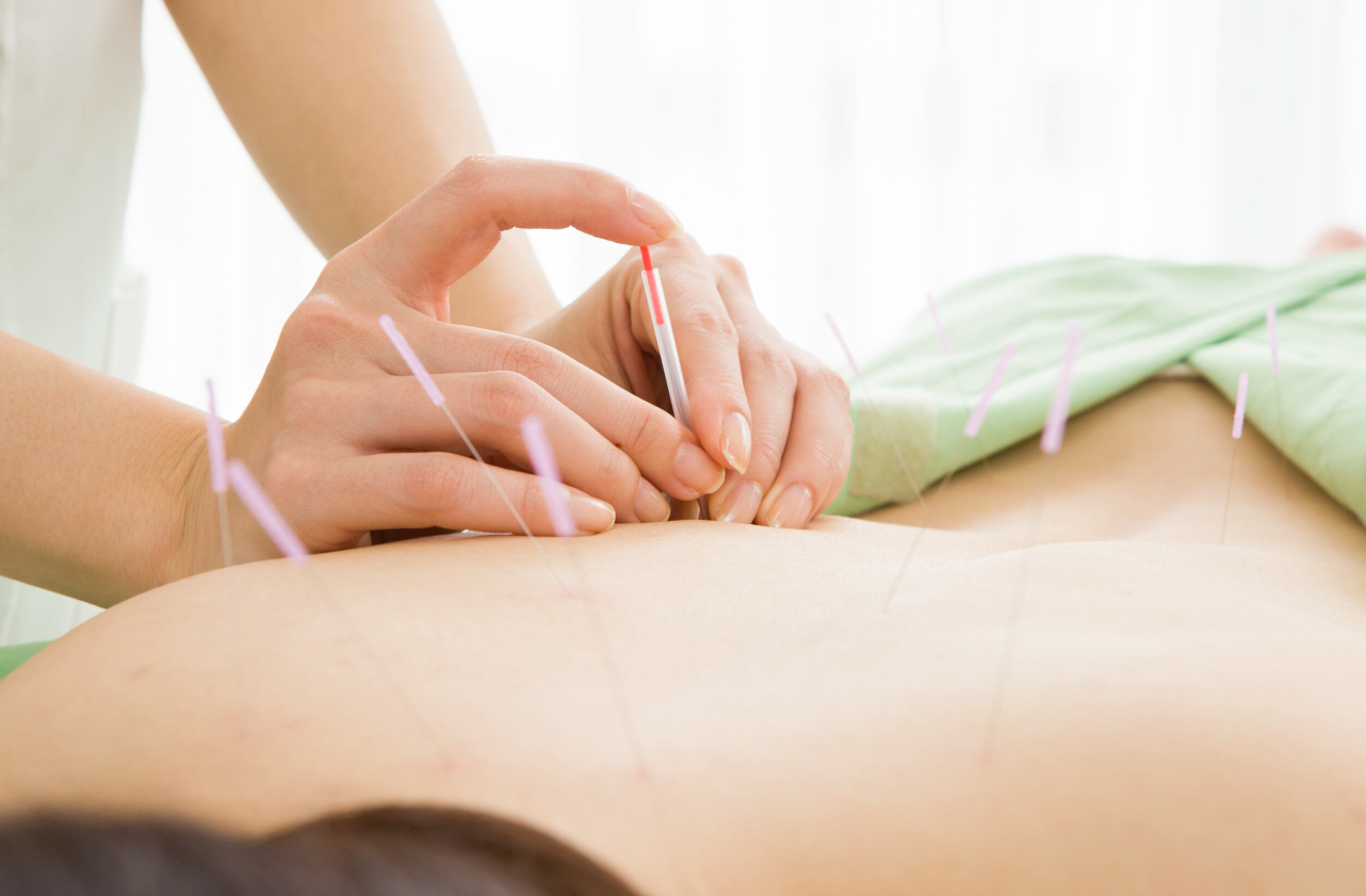 Acupuntura: Servicios de Fisiocentre Salut