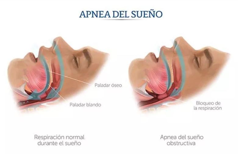 Tratamiento de la apnea del sueño: Tratamientos de Sonría Odontólogos Tratamiento de la apnea del sueño: Tratamientos de Sonría Odontólogos