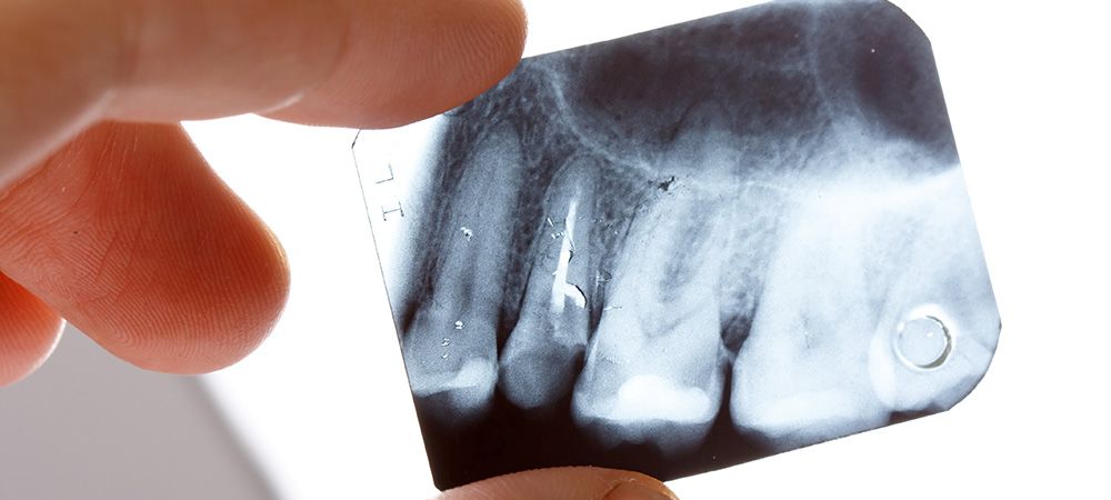 Endodoncia: Tratamientos de Sonría Odontólogos Endodoncia: Tratamientos de Sonría Odontólogos
