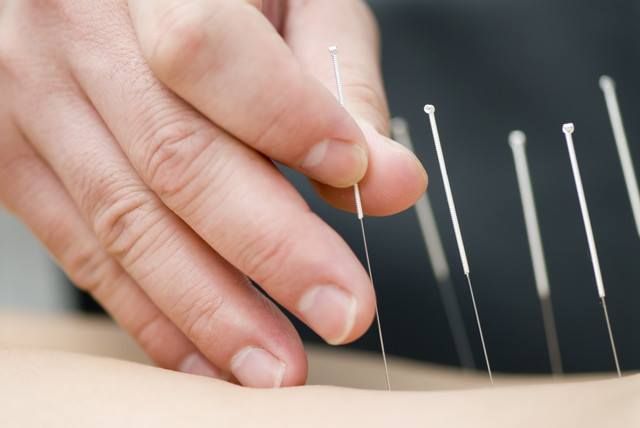 Acupuntura: Servicios de BenuSalud Acupuntura: Servicios de BenuSalud