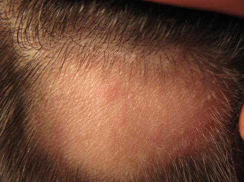 Tratamientos de alopecia: Servicios de Nueva Imagen Tratamientos de alopecia: Servicios de Nueva Imagen