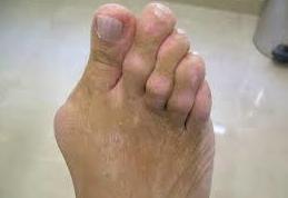 Juanetes o Hallux valgus: Cirugía del Pie de Clínica Podológica José Mª Pe Duarte Juanetes o Hallux valgus: Cirugía del Pie de Clínica Podológica José Mª Pe Duarte