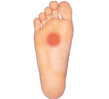 Metatarsalgia: Cirugía del Pie de Clínica Podológica José Mª Pe Duarte Metatarsalgia: Cirugía del Pie de Clínica Podológica José Mª Pe Duarte