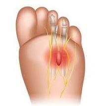 Neuroma de Morton: Cirugía del Pie de Clínica Podológica José Mª Pe Duarte Neuroma de Morton: Cirugía del Pie de Clínica Podológica José Mª Pe Duarte