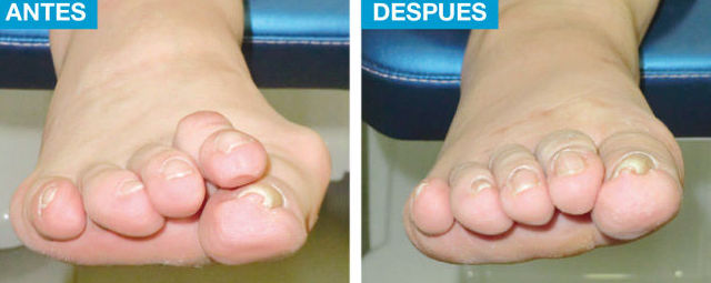 Problemas de dedos Menores: Cirugía del Pie de Clínica Podológica José Mª Pe Duarte Problemas de dedos Menores: Cirugía del Pie de Clínica Podológica José Mª Pe Duarte