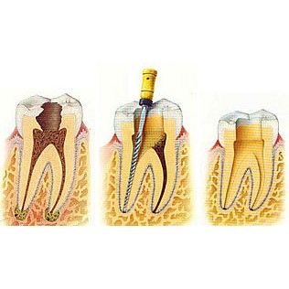 Endodoncia: Tratamientos de Clident Endodoncia: Tratamientos de Clident