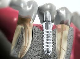 Implantología: Tratamientos de Clident Implantología: Tratamientos de Clident