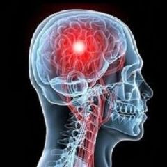 Accidente cerebrovascular: Una mirada fonoaudiológica
