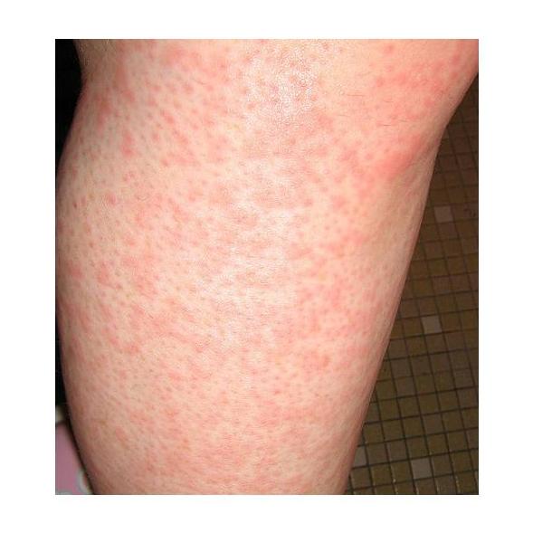 Piel: Especialidades de Dr. García Robaina Alergólogo Piel: Especialidades de Dr. García Robaina Alergólogo