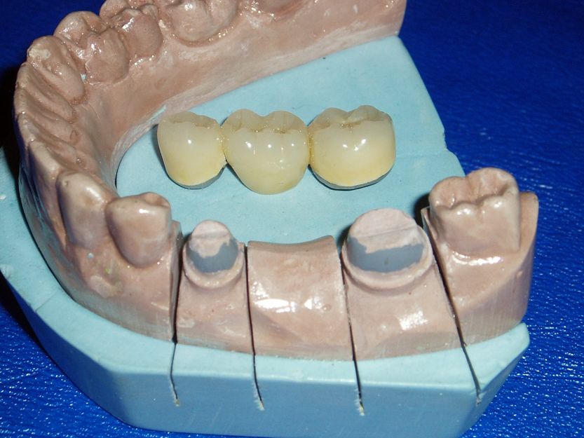 Prótesis dental en Llerena, Badajoz