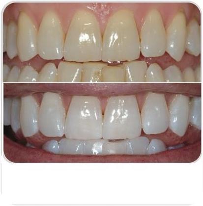 Blanqueamiento dental: Tratamientos de Clínica Dental Fortaña-Giménez Blanqueamiento dental: Tratamientos de Clínica Dental Fortaña-Giménez