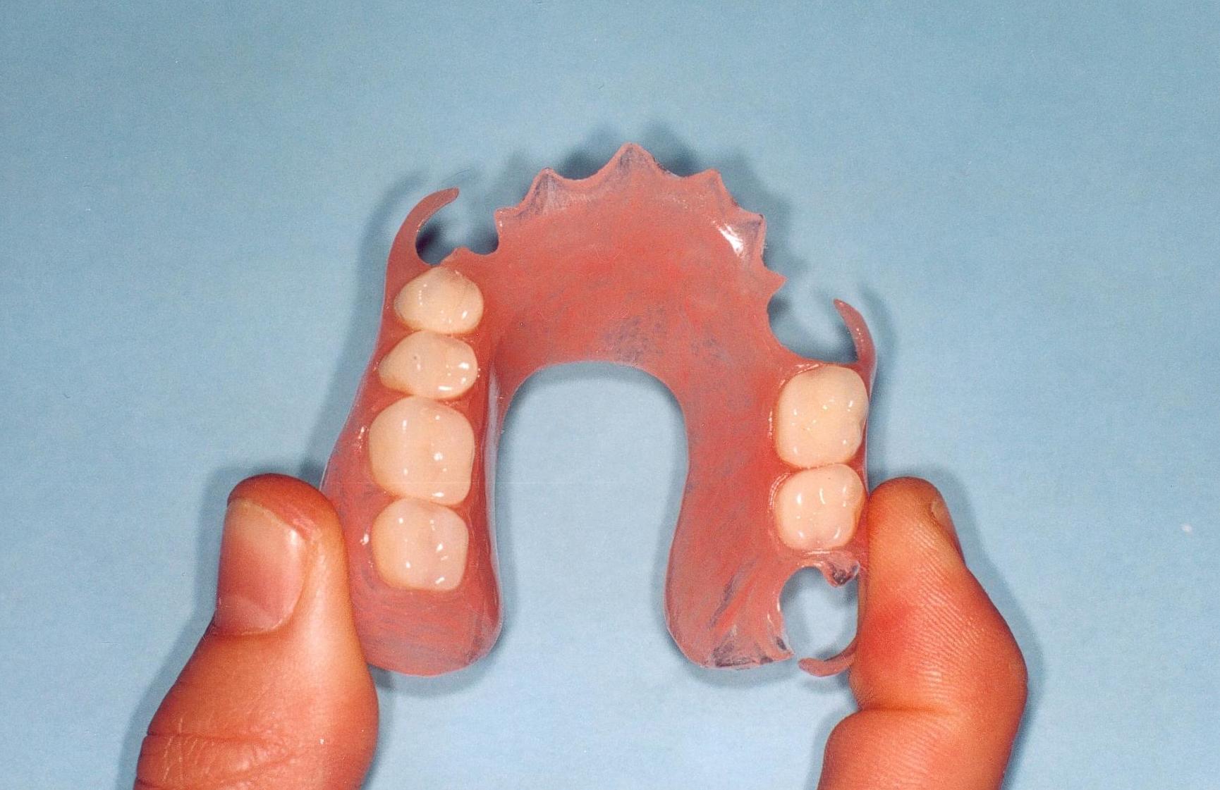 Protesis removible: Tratamientos de Clínica Dental Fortaña-Giménez