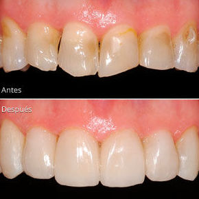 Carillas dentales: Tratamientos de Clínica Dental Fortaña-Giménez Carillas dentales: Tratamientos de Clínica Dental Fortaña-Giménez