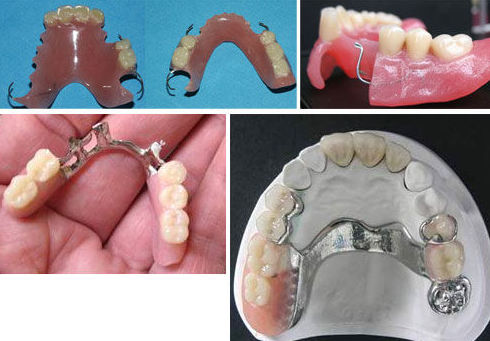 Protesis removible: Tratamientos de Clínica Dental Fortaña-Giménez Protesis removible: Tratamientos de Clínica Dental Fortaña-Giménez