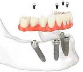 PRÓTESIS DENTALES: ESPECIALIDADES de Clínica Dental Morey