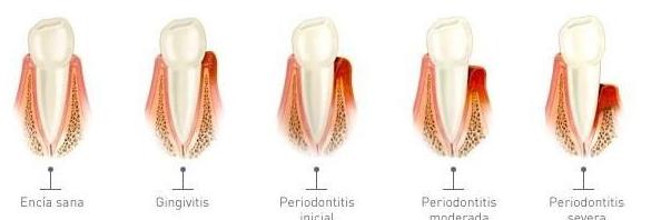 Periodoncia: Especialidades de Centro Dental Unamuno Periodoncia: Especialidades de Centro Dental Unamuno
