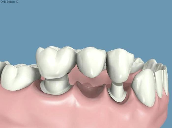 Prótesis dentales fijas o removibles: Especialidades de Centro Dental Unamuno Prótesis dentales fijas o removibles: Especialidades de Centro Dental Unamuno