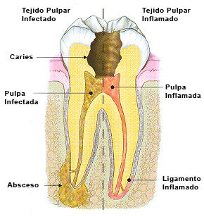 Endodoncia : Especialidades de Centro Dental Unamuno Endodoncia : Especialidades de Centro Dental Unamuno