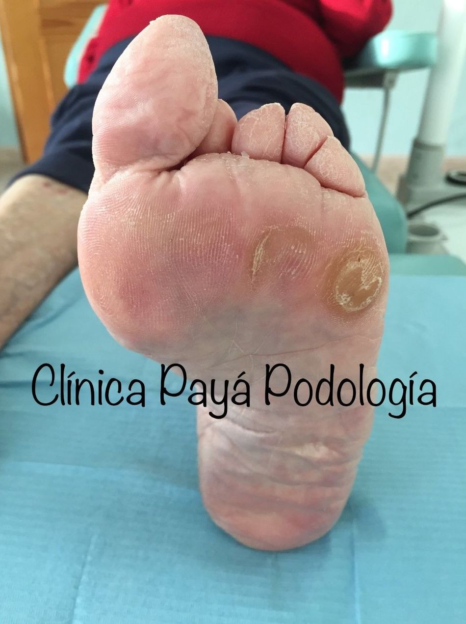 Podología Geriátrica: Tratamientos de Clínica Payá Podología Podología Geriátrica: Tratamientos de Clínica Payá Podología