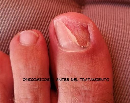 Podología general: Tratamientos de Clínica Payá Podología Podología general: Tratamientos de Clínica Payá Podología