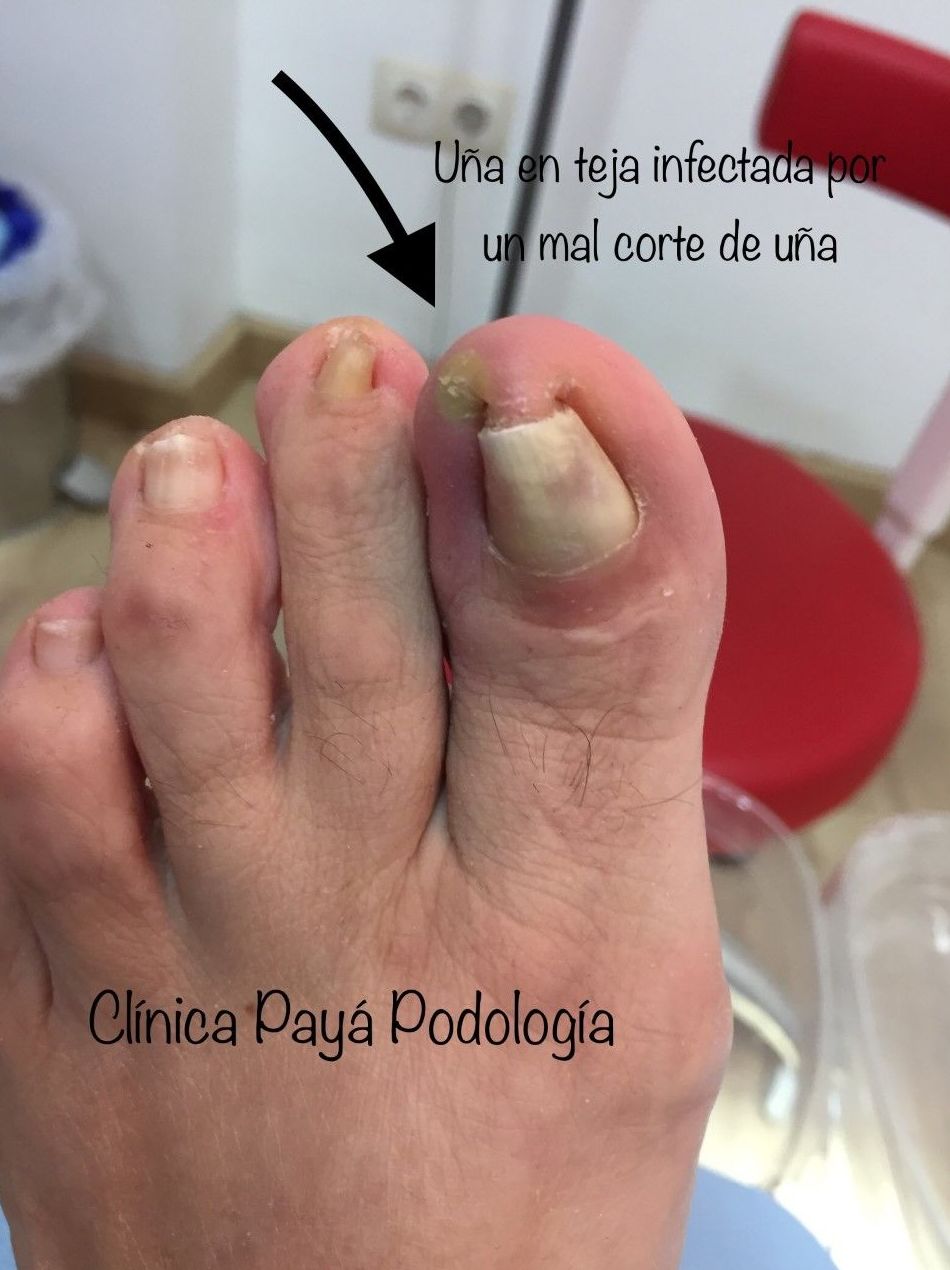Podología Geriátrica: Tratamientos de Clínica Payá Podología Podología Geriátrica: Tratamientos de Clínica Payá Podología