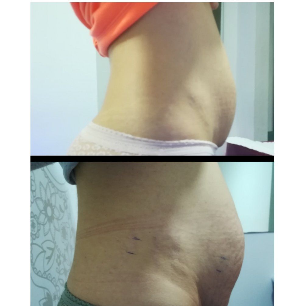 Tratamiento facial y corporal Hifu: Servicios de Patri Calderón Estetic Tratamiento facial y corporal Hifu: Servicios de Patri Calderón Estetic