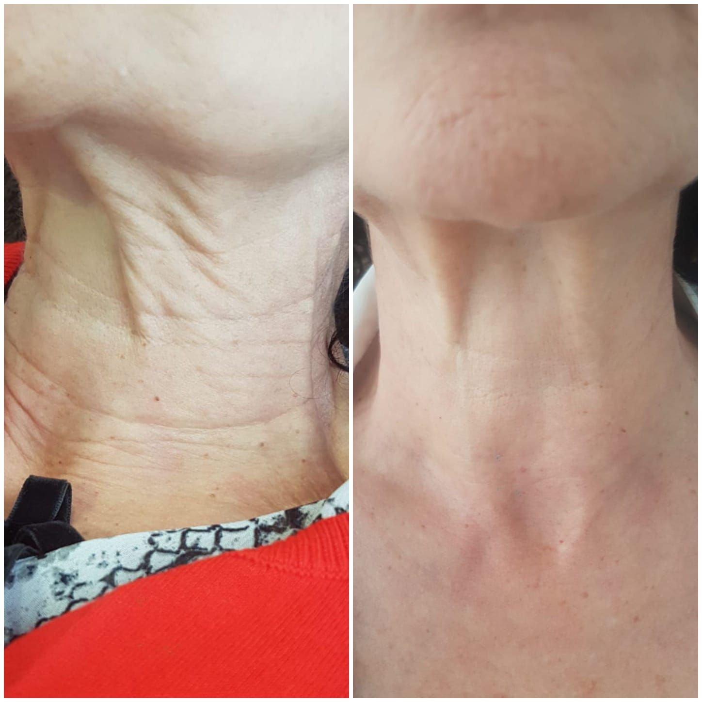Tratamiento facial y corporal Hifu: Servicios de Patri Calderón Estetic Tratamiento facial y corporal Hifu: Servicios de Patri Calderón Estetic