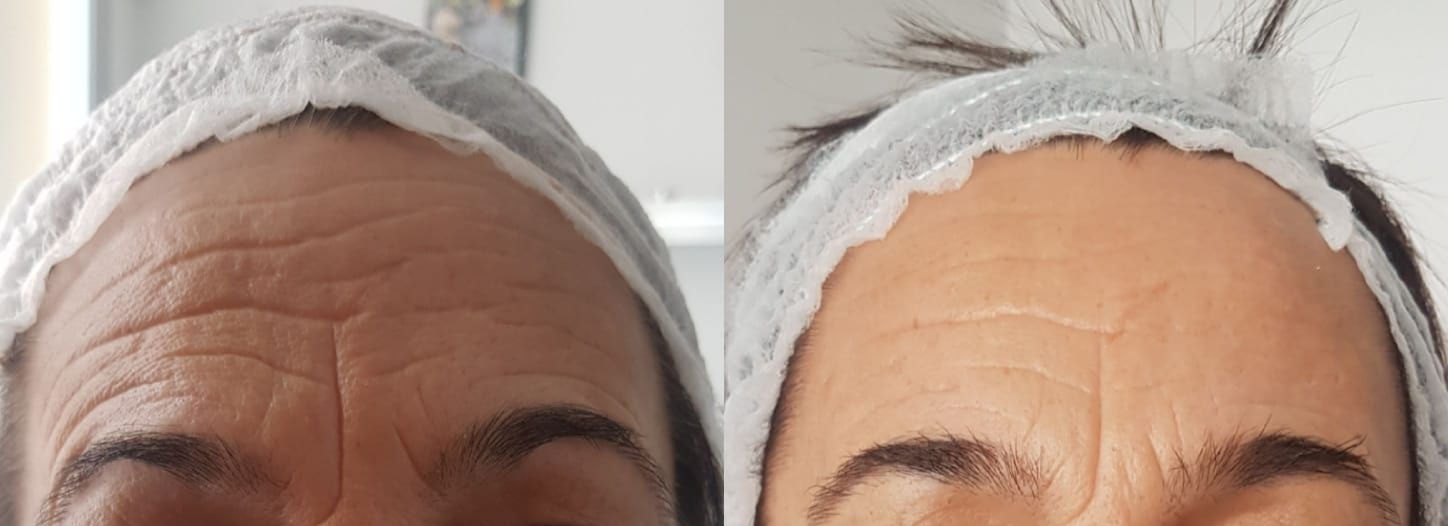 Tratamiento facial y corporal Hifu: Servicios de Patri Calderón Estetic Tratamiento facial y corporal Hifu: Servicios de Patri Calderón Estetic