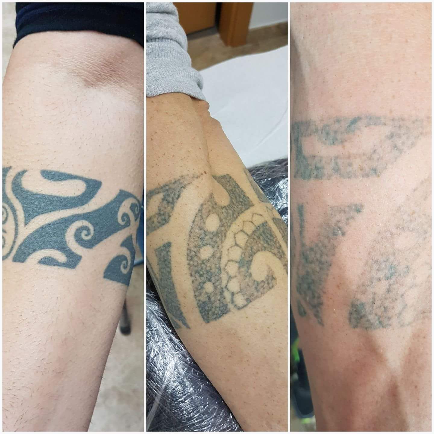 Eliminación de tatuajes: Servicios de Patri Calderón Estetic Eliminación de tatuajes: Servicios de Patri Calderón Estetic