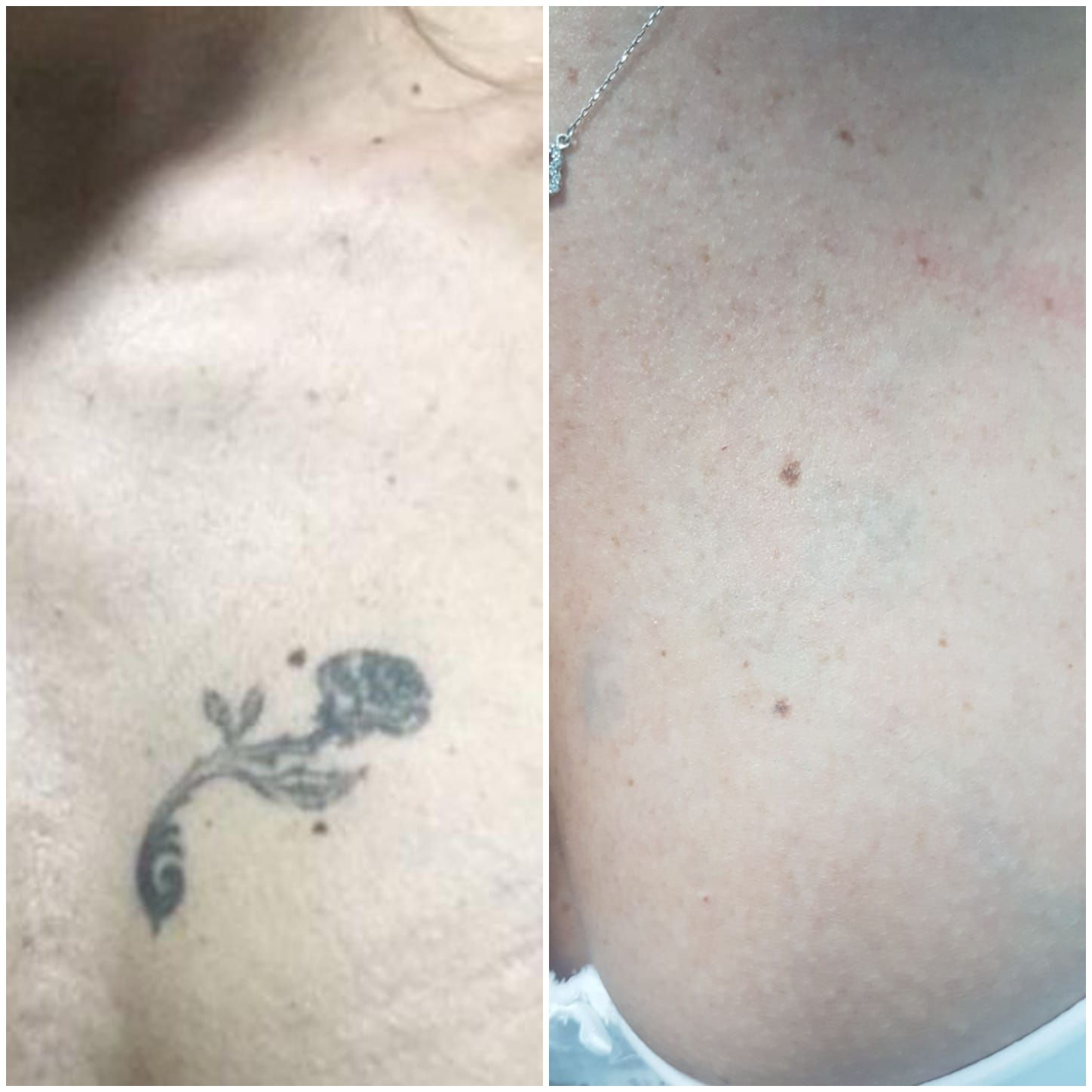 Eliminación de tatuajes: Servicios de Patri Calderón Estetic Eliminación de tatuajes: Servicios de Patri Calderón Estetic