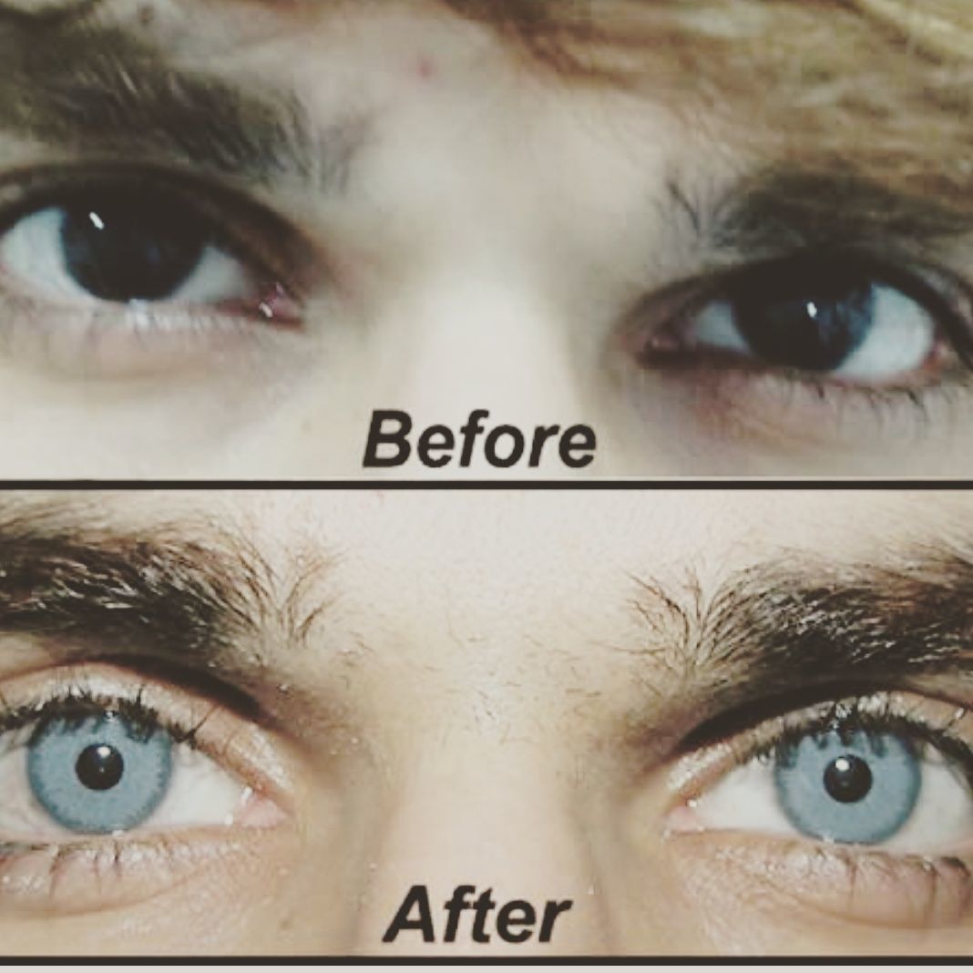 Глаза человека меняют цвет. Осветление цвета глаз лазером. Операция по изменению цвета глаз. Операция по изменению цвета глаз карие. Изменение пигмента глаз.