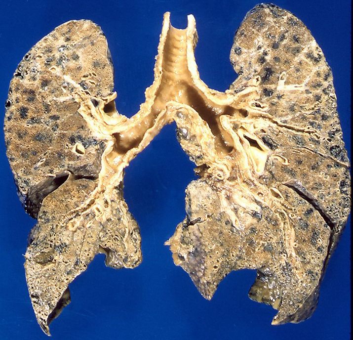 Enfisema: Neumología de José María Ignacio Garcia Enfisema: Neumología de José María Ignacio Garcia