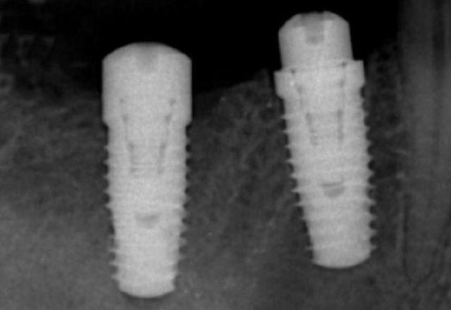 Implantes: Tratamientos de Abando Hortz Klinika Implantes: Tratamientos de Abando Hortz Klinika
