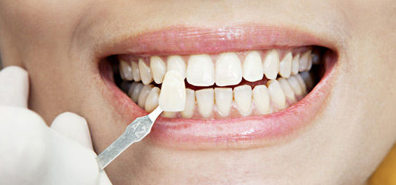 Estética dental: Tratamientos de Abando Hortz Klinika Estética dental: Tratamientos de Abando Hortz Klinika
